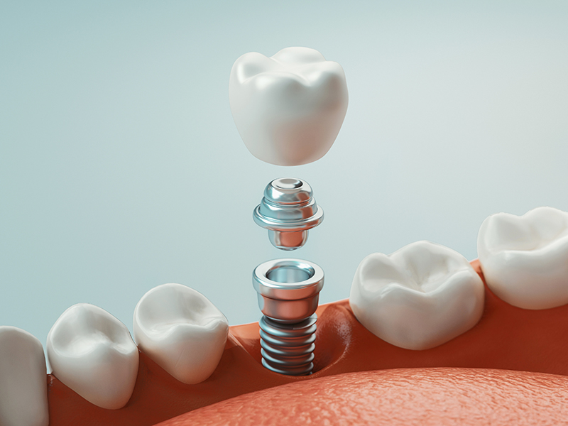 Dental implant restoration dentists in Ann Arbor MI